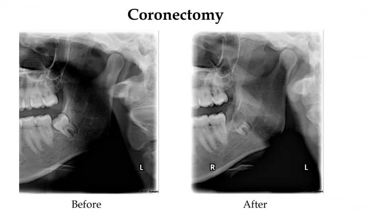 xrays showing before and after coronectomy