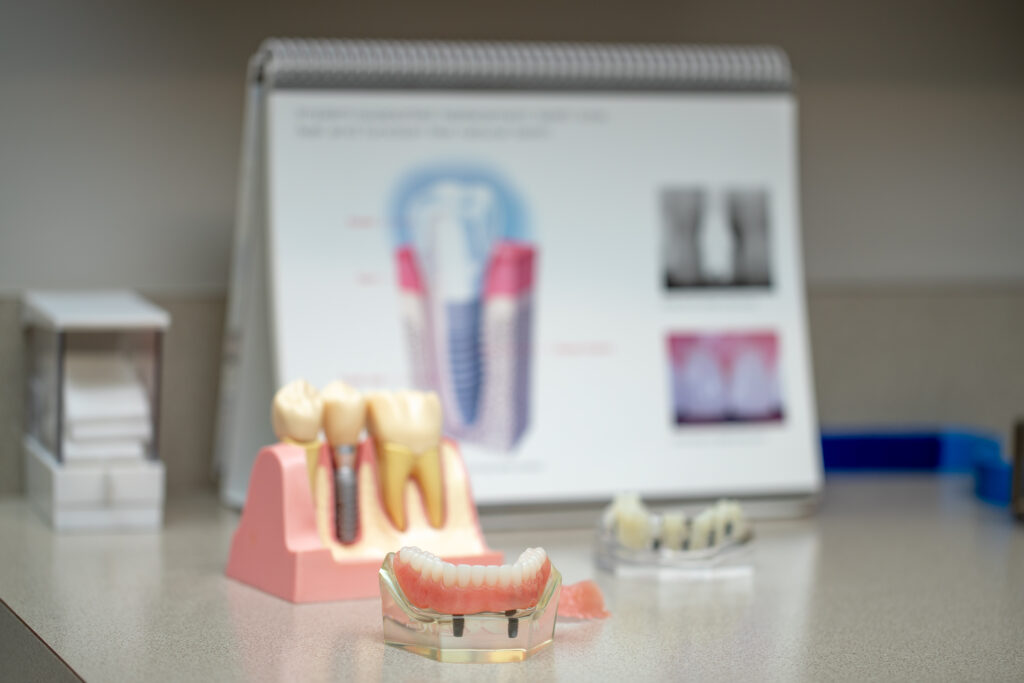 dental implant models and chart