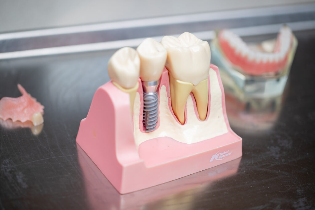 model of dental implant placement