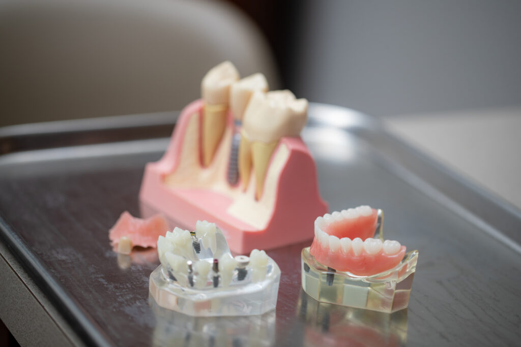 models of dental implant supported overdenture