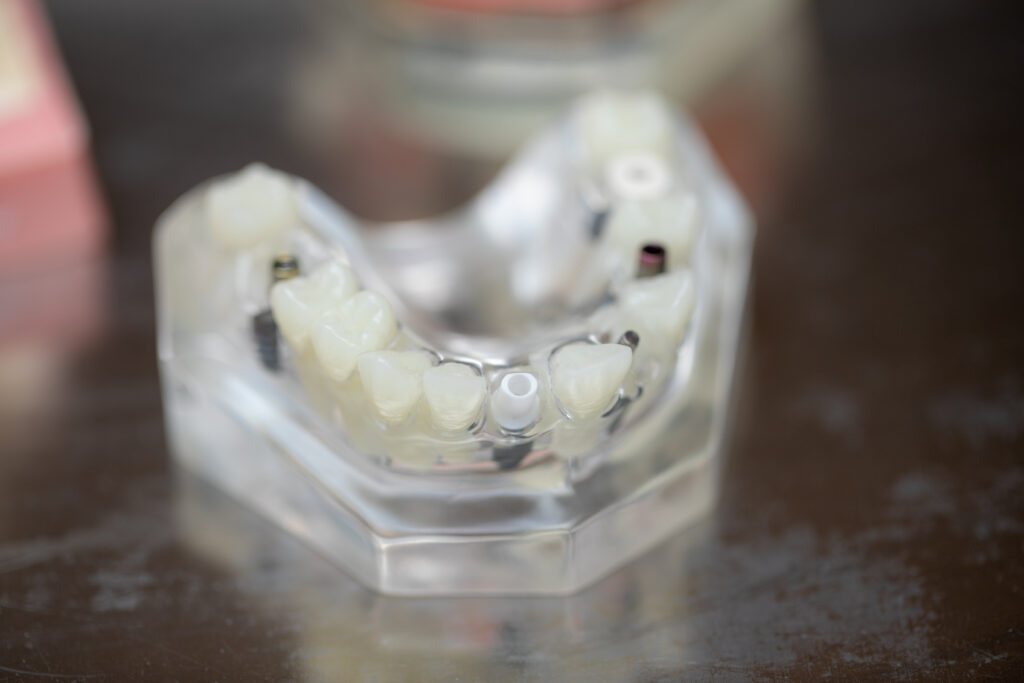 model to show fully functioning teeth on dental implants in about an hour Teeth in an hour