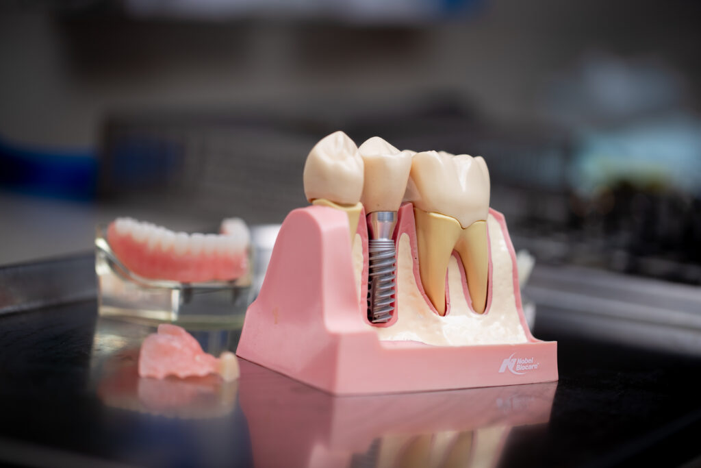 model of ceramic dental implants