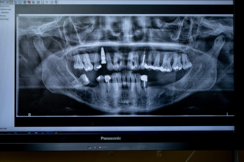 full mouth xray showing dental implants