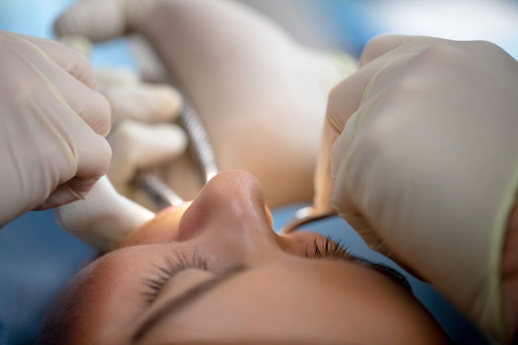 gauze being put in a patient's mouth after wisdom tooth removal