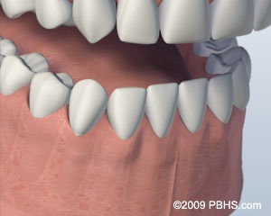 graphic of lower jaw with individual dental implants following completed healing