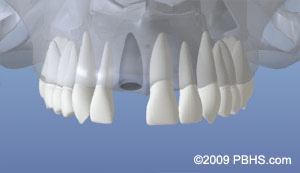 graphic showing upper jaw bone with tooth loss