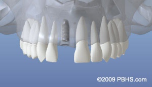 graphic of upper jaw with implant placed