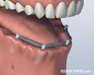 jaw with missing lower teeth with implants placed