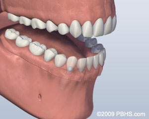 graphic of lower jaw with dentures attached