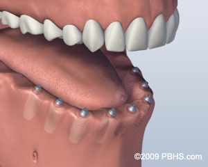 graphic of jaw missing lower teeth with screw retained denture implants placed