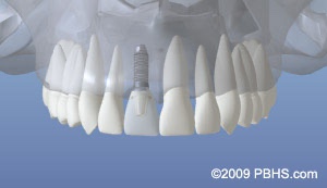 graphic showing normal implant placement