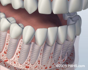 graphic of lower jaw with individual dental implants placed