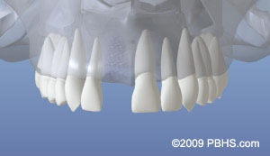 graphic of upper jaw with a healed bone