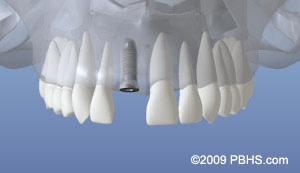 graphic of upper jaw with implant placed and bone healing