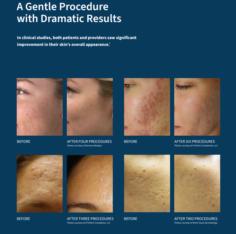 A gentle procedure with dramatic results, images of skin following microneedling