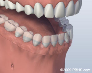 lower jaw with dentures attached