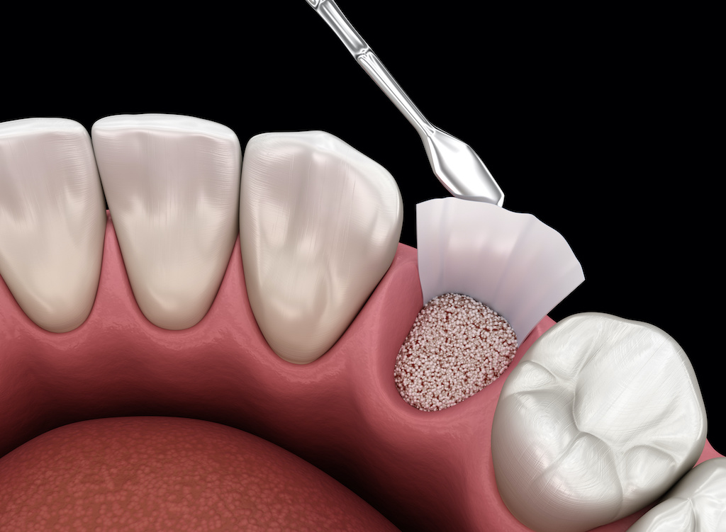 bone grafting graphic