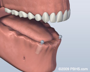 graphic of jaw missing lower teeth with implants placed