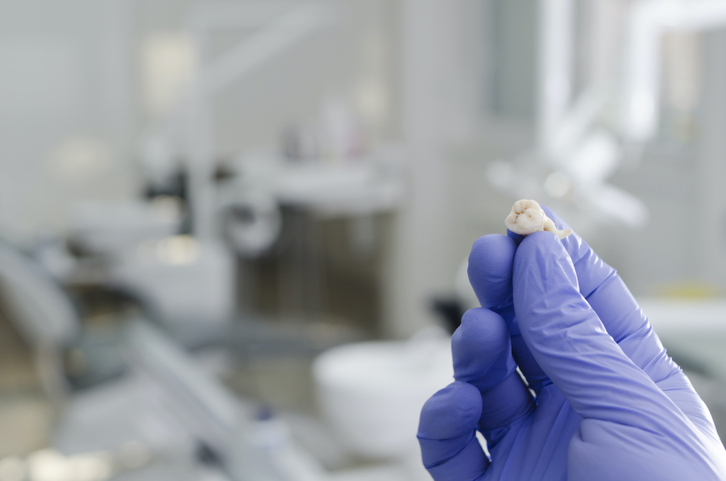 gloved hand holding a tooth following tooth extraction