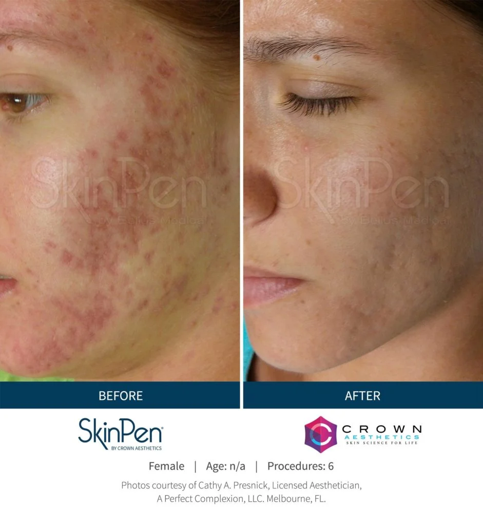 woman's profile with before and after microneedling procedure