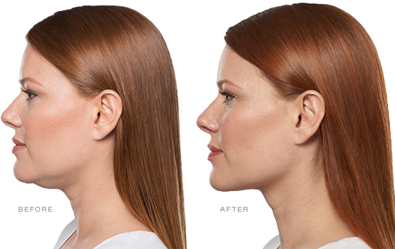 woman's side profile showing before and after of Kybella