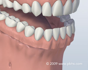 graphic of denture