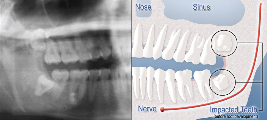 diagram of xray and impacted wisdom teeth