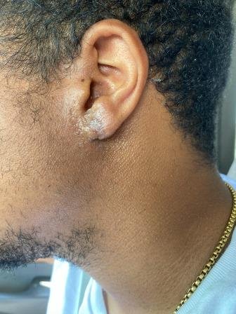 earlobe repair two weeks post op