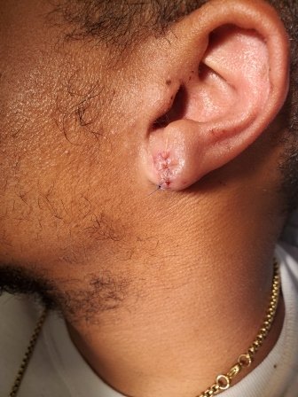 earlobe in the process of healing following earlobe repair