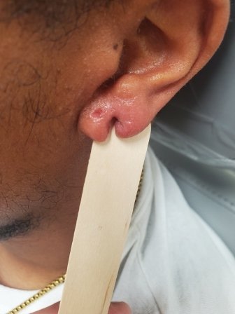 torn earlobe before earlobe repair