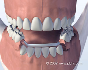 graphic of metal partial