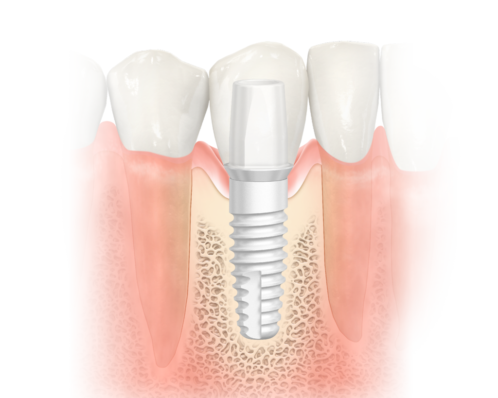 graphic of ceramic dental implants