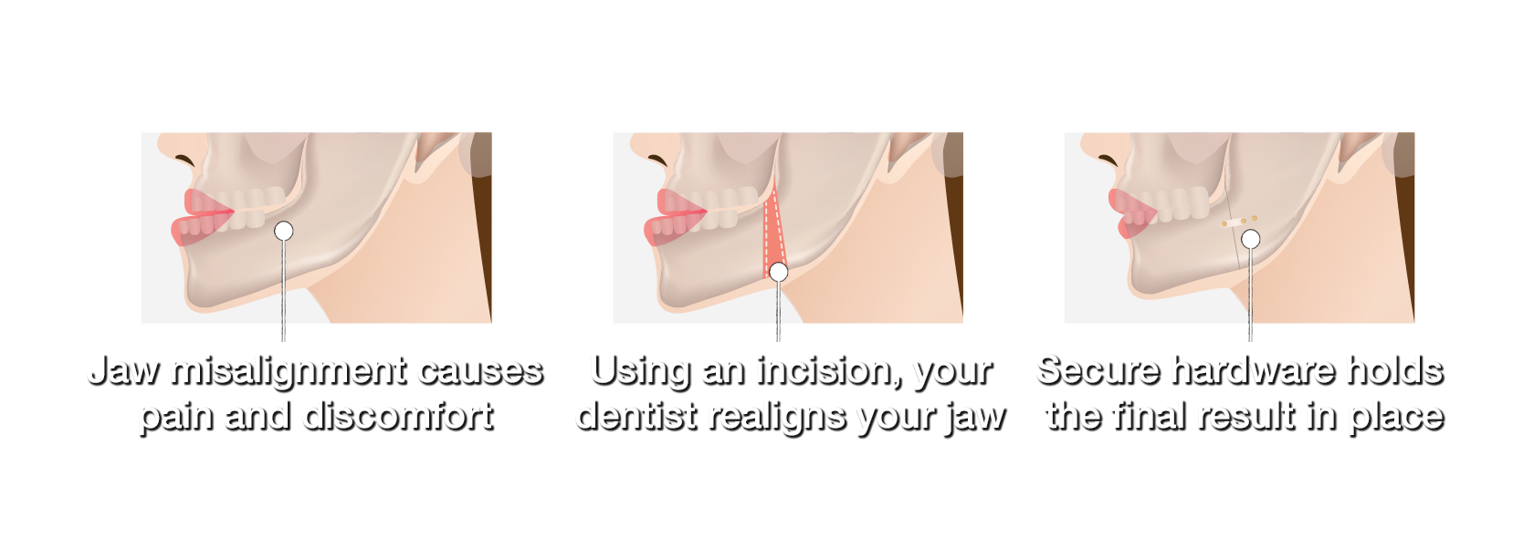 three jaw graphics showing jaw misalignment, an incision, and secure hardware following corrective jaw surgery