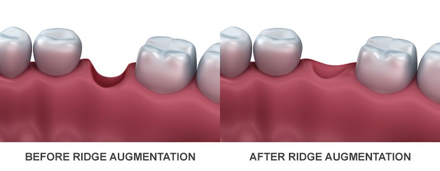 graphic showing jawbone before and after ridge augmentation