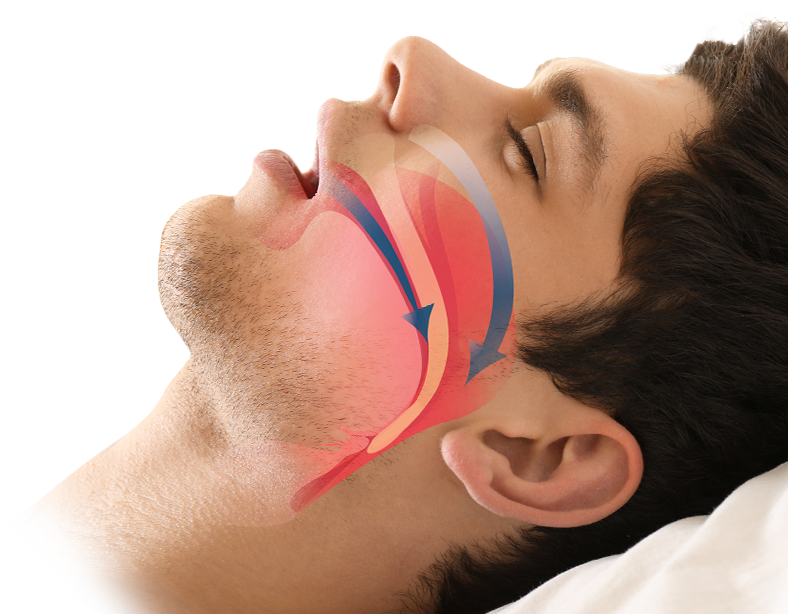 man sleeping on his back with mouth open and graphic overlay with arrows showing airways