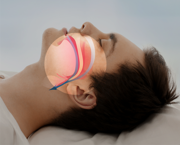 man sleeping with graphic showing his airways with sleep apnea treatment