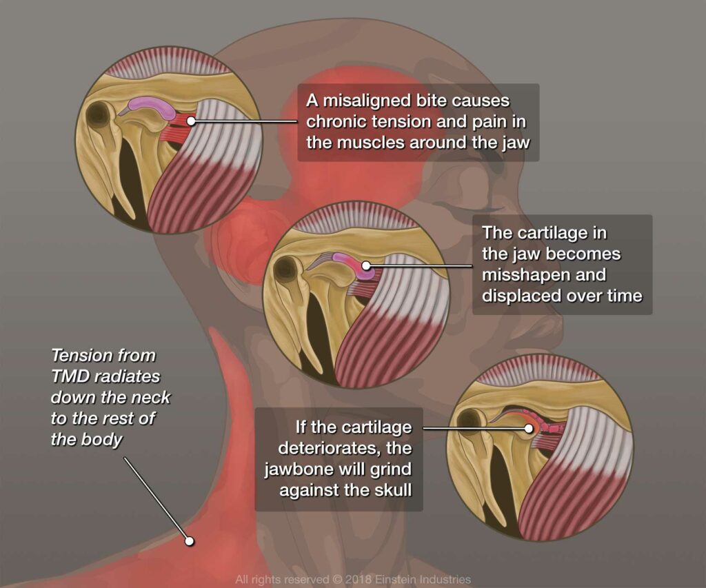 graphic showing TMJ disorder issues