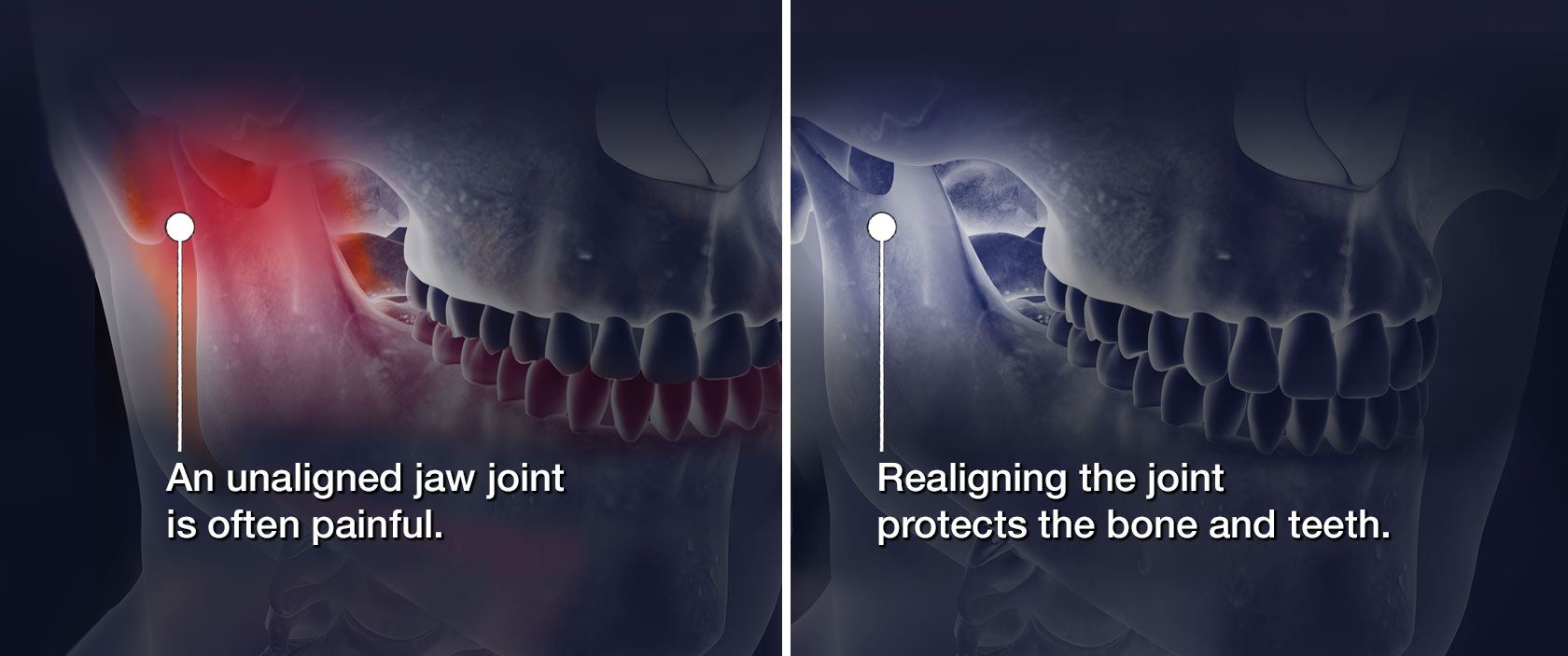 graphic showing a painful unaligned jaw joint and a realigned joint protecting the bone and teeth